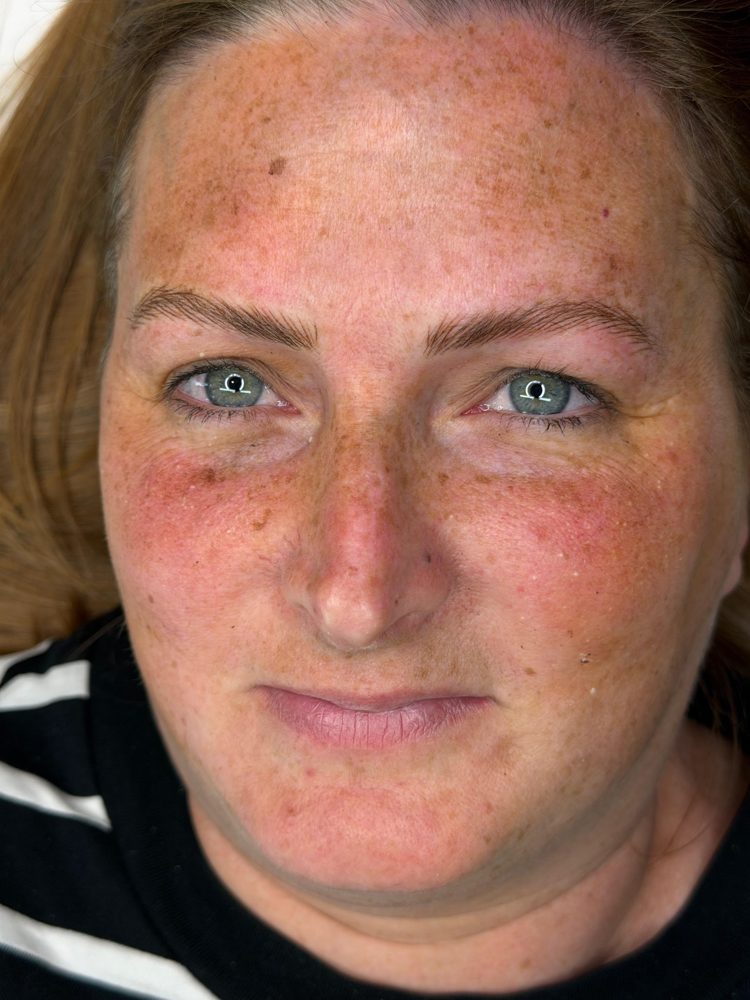Over-plucked eyebrows restored, healed result